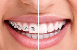 split view of braces on and off