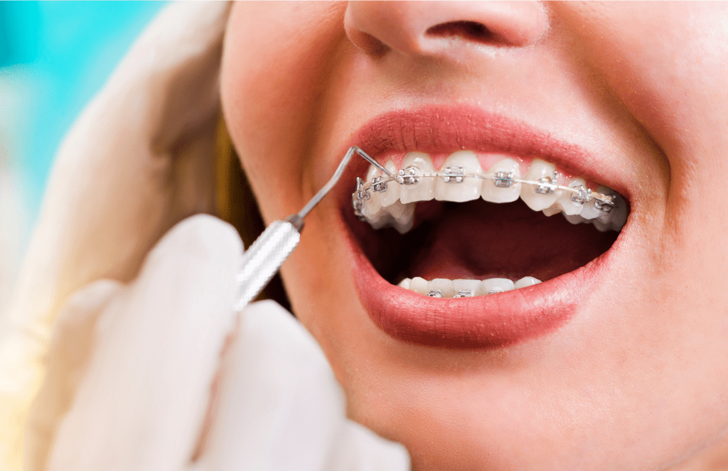 open mouth showing braces
