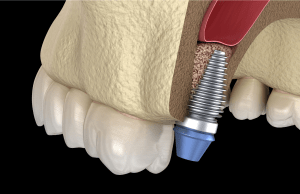 dental implant illustration