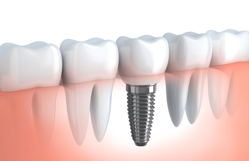 ilustración de implante dental