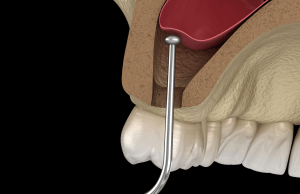 sinus lift illustration