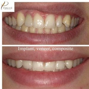 Fotos de cambio de imagen de sonrisa - implante, chapa, compuesto