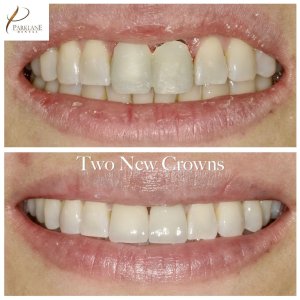 before and after photos of two new crowns