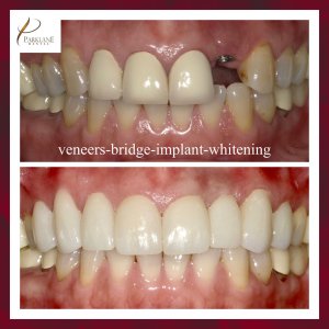 Before & After for Dental Veneers, Puente, e Implante para Smilemakeover