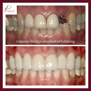 Before & After for Dental Veneers, Puente, e Implante para Smilemakeover