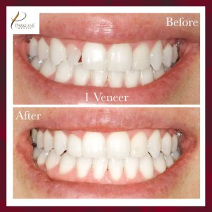 Antes y después de 1 Carilla dental para cambio de imagen de sonrisa