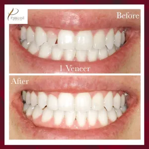 Antes y después de 1 Carilla dental para cambio de imagen de sonrisa