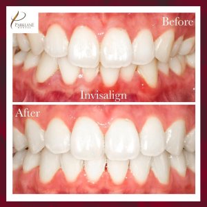 在 Parklane 牙科诊所进行微笑改造之前和之后的 Invisalign