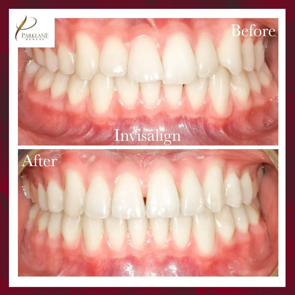 Invisalign Image Invisalign Smile Gallery | Before & After's | Parklane Dental