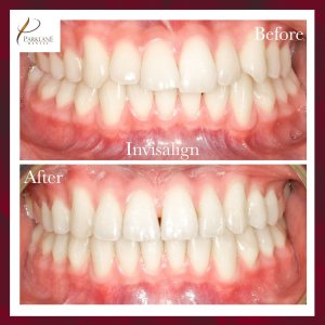 在 Parklane 牙科诊所与美容牙医进行 Invisalign 治疗前后