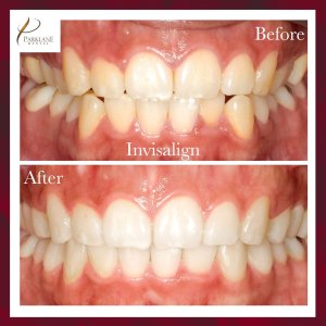 使用 Parklane 牙科进行微笑改造之前和之后的 Invisalign