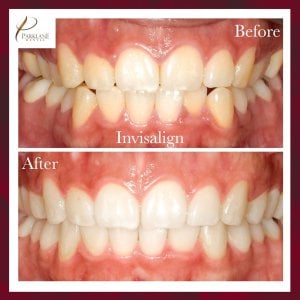 Invisalign before and after with Parklane Dental for Smile Makeover