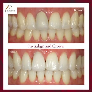 Parklane 牙科诊所 Invisalign 和牙冠用于美容牙科的微笑前后结果