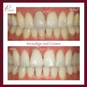 Before and After Smile Result of Invisalign and Dental Crown for Cosmetic Dentistry at Parklane Dental
