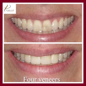 Before and After for 4x Cosmetic Veneers for Smile Makeover for Parklane Dental