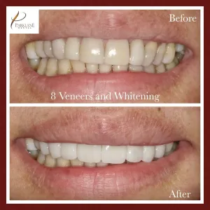 Antes y después del blanqueamiento dental y las carillas dentales para el cambio de imagen de la sonrisa