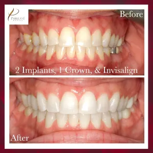 Before & After for dental implants, crown, and invisalign for smile makeover at Parklane Dental
