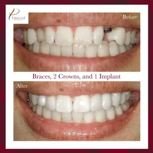 Before and After of Braces, Crowns, and Implants for Smile Makeover at Parklane Dental