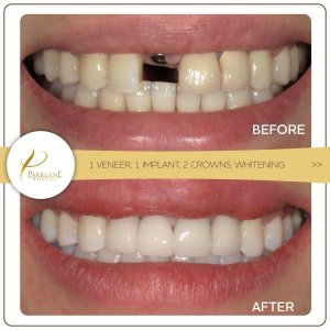 Before and After for Veneer, Implante, corona, and Whitening for Smile Makeover at Parklane Dental