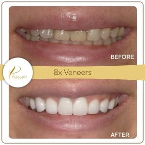 Cambio de imagen cosmético de la sonrisa con 8 unidades de carillas en una foto de resultado de antes y después