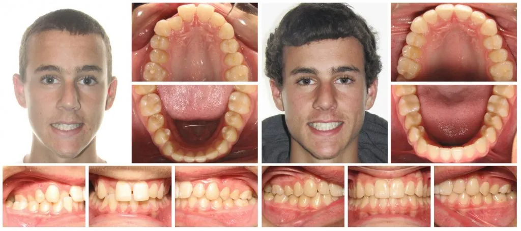 青少年男性患者 Invisalign 前后
