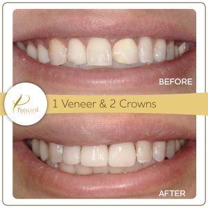 Before & after of a Smile Makeover with 1 デンタルベニアのユニットと 2 Parklane Dental の審美歯科用歯科用クラウン