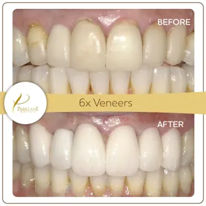 Before and After Photos of Smile Makeover with 5 units of Dental Veneers for Cosmetic Dentistry at Parklane Dental