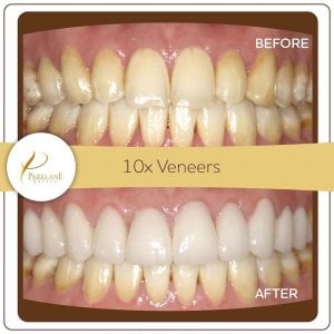 Smile Makeover with 10 units of Dental Veneers at Parklane Dental
