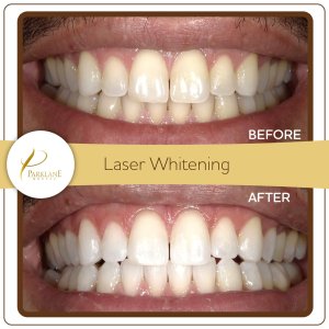 Photos of the before and after results of shade difference from laser teeth whitening with cosmetic dentist in Arcadia