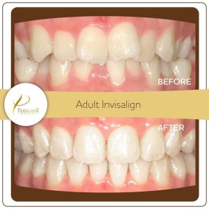 Invisalign before and after with Parklane Dental for Smile Makeover