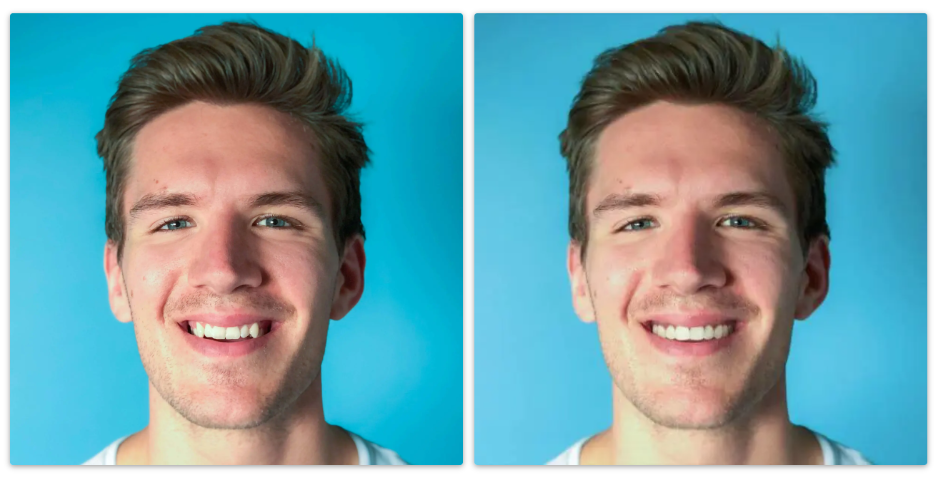 Face shot of Invisalign before and after with Parklane Dental for Smile Makeover