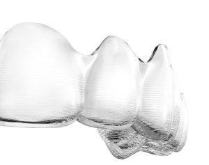 Close-up shot of the transparent Vivera retainers to show the durability and strength of the material