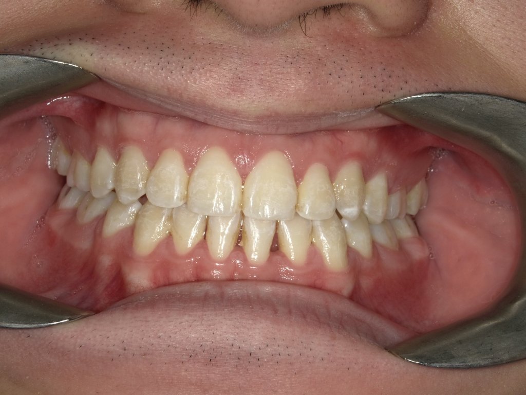 See an “after braces” smile photo showcasing the amazing results achieved at Parklane Dental.

