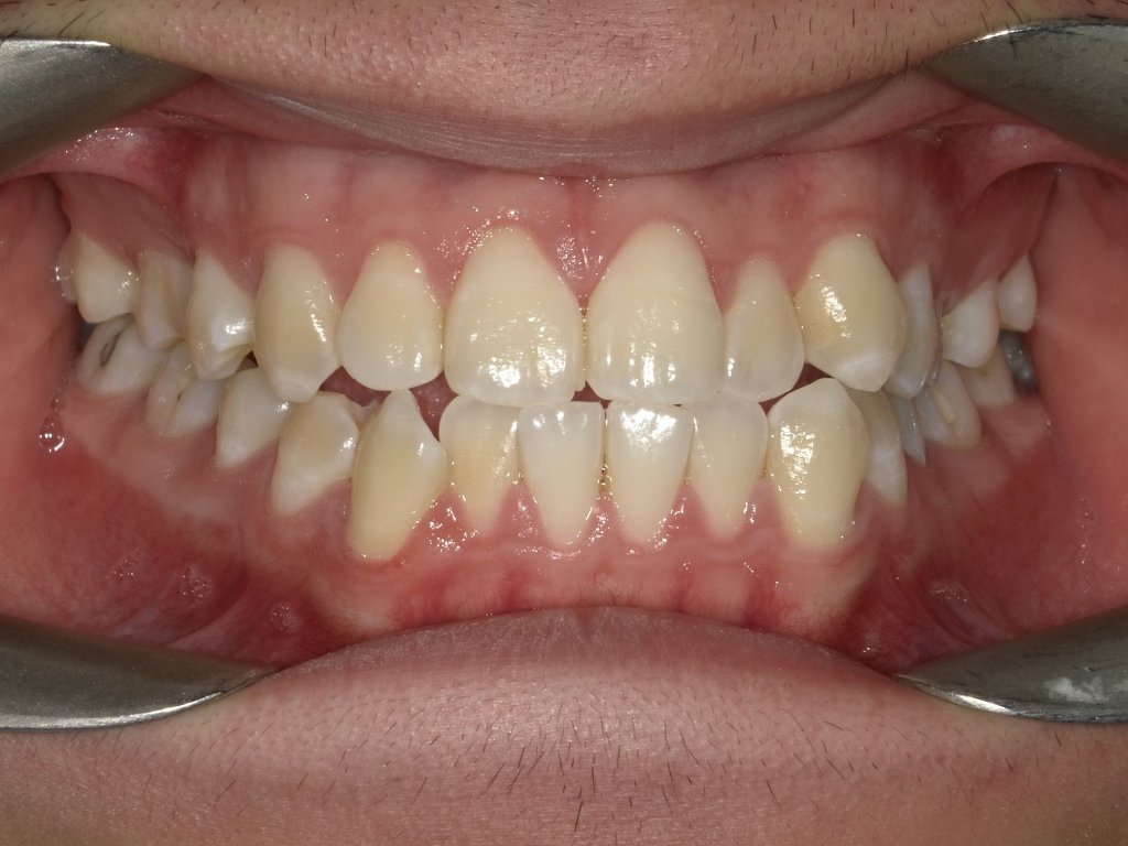 View a “before braces” smile image from Parklane Dental—see the starting point of smile transformations.

