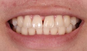 Photo of a before smile for Bioclear treatment to close gap with cosmetic dentist in Arcadia