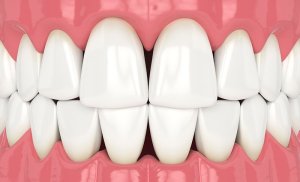 Simulation of what black triangles that can be closed with Bioclear treatment with Arcadia dentist