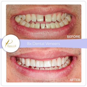 Smile makeover with porcelain veneers &ndash; before and after teeth gaps and poor bite treatment