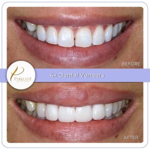 Smile makeover with porcelain veneers &ndash; before and after treatment