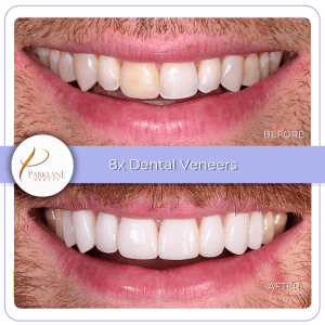 Smile makeover with porcelain veneers &ndash; before and after for upper front teeth