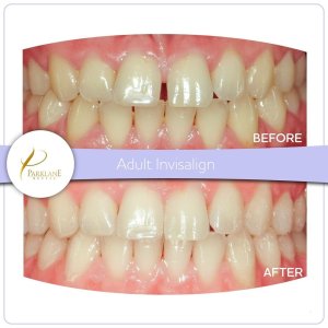 Before and after photo of a woman's teeth with gaps corrected with Invisalign.