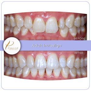 Before and after photos of a woman's overbite teeth straightened with Invisalign.