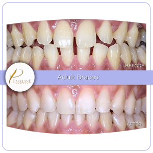 Before and after photo of an adult's smile with an open bite corrected using braces.