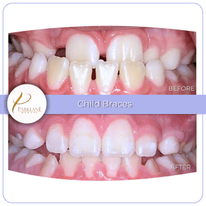 Before and after photo of a child boy's smile corrected with traditional braces.