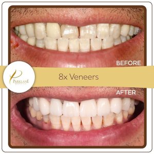 8 Veneers for Gaps & Whitening Alternative | Temple City Smile Makeover
