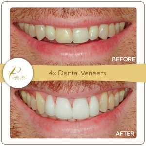 Before and after redo of a failed veneer &ndash; アルカディアの歯医者