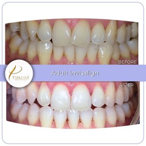 Before and after photos of a woman's crooked teeth and crossbite teeth straightened with Invisalign.