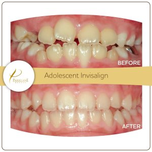Invisalign before and after for crowding in top and bottom teeth for young adolescent female, with our orthodontist in Arcadia