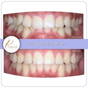 Before and after photos of a young adolescent child's overbite, now straightened with Invisalign with our Arcadia orthodontist