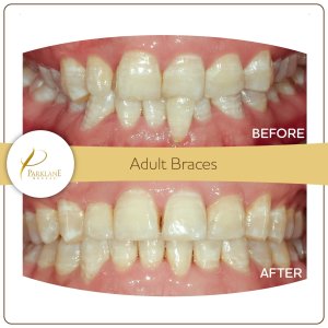 Before and after braces for crowded teeth &ndash; 32-year-old engineer in Arcadia treated with orthodontist in Arcadia at Parklane Dental