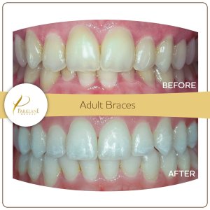 Adult braces before and after smile transformation &ndash; Temple City business owner, with our orthodontist in Arcadia to fix inward facing teeth